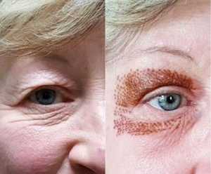fibroblast tightening plasma skin fibroblasting before eyelid treatment laser pen upper lower lift eyelids procedure treatments lifting non surgical eyebrows