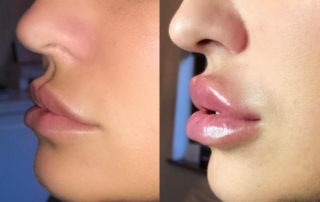 Non-Invasive Lip Fillers Maidstone