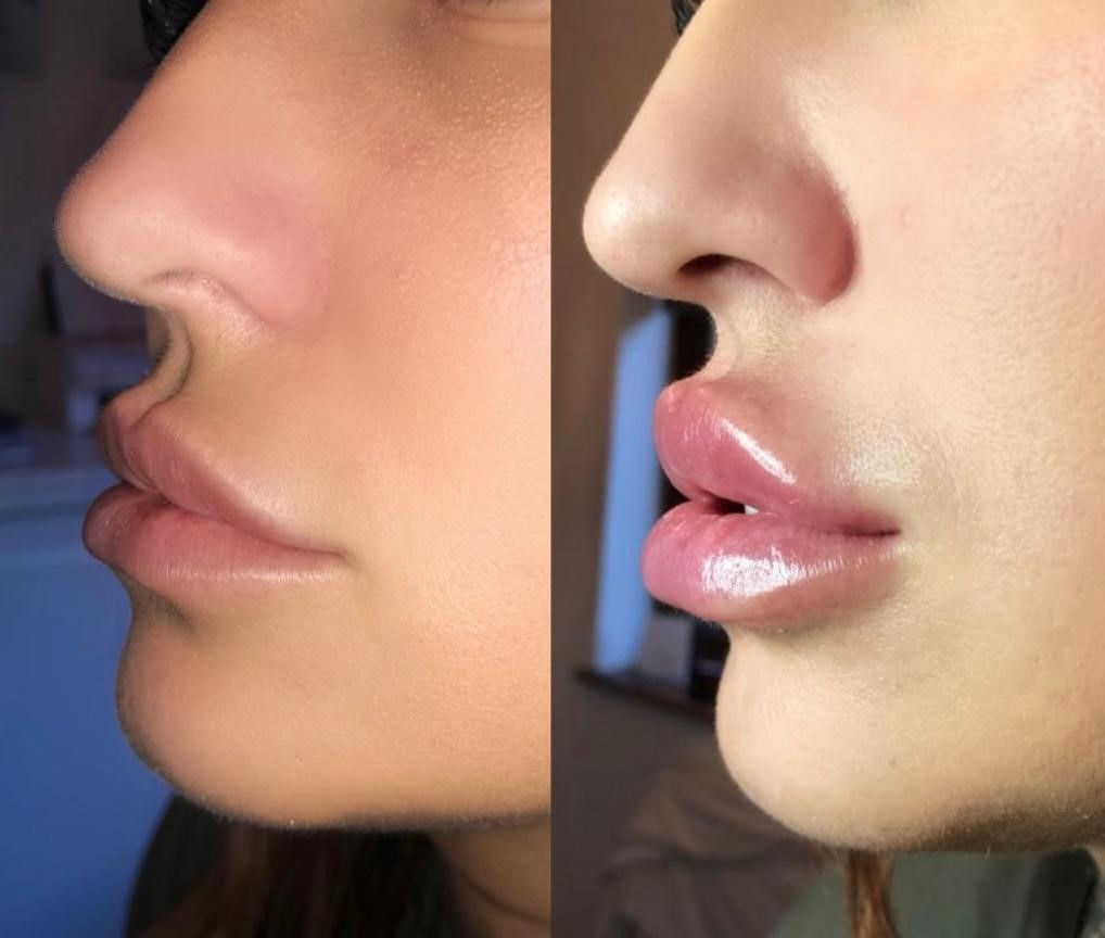 Non-Invasive Lip Fillers Maidstone
