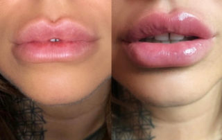 Non-Invasive Lip Fillers Maidstone