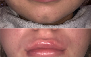 Non-Invasive Lip Fillers Maidstone