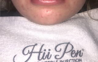 Non-Invasive Lip Fillers Maidstone