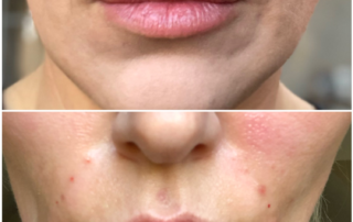 Non-Invasive Lip Fillers Maidstone