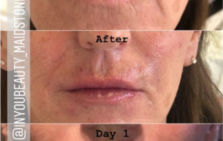 Non-Invasive Lip Fillers Maidstone