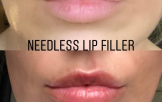 Non-Invasive Lip Fillers Maidstone